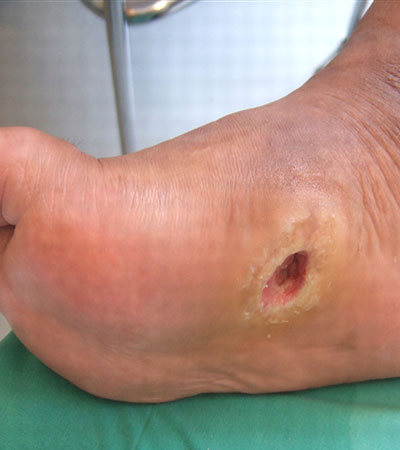 Diabetic Foot care treatment in ongole